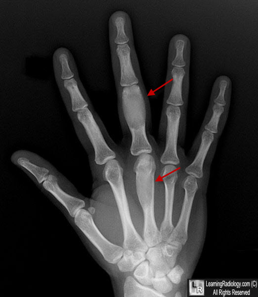 Fibrous Dysplasia